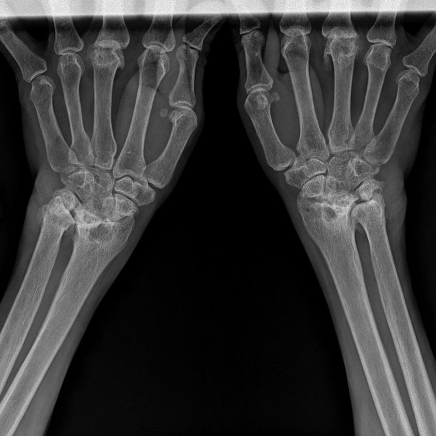 Carpal Tunnel St. Petersburg Florida – Hood Chiropractic Carpal Tunnel St. Petersburg Florida - Hood Chiropractic