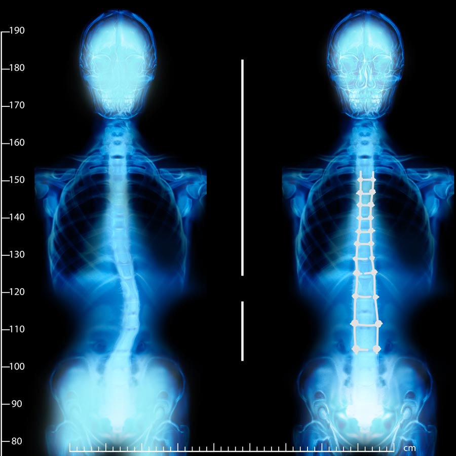 Scoliosis St. Petersburg Florida – Hood Chiropractic Scoliosis St. Petersburg Florida - Hood Chiropractic