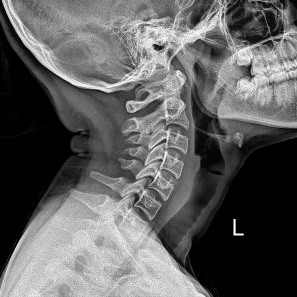 Neck Xray at Hood Chiropractic in St. Petersburg FL