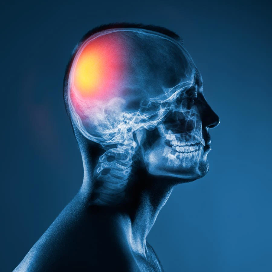Headaches & Migraines St. Petersburg Florida - Hood Chiropractic