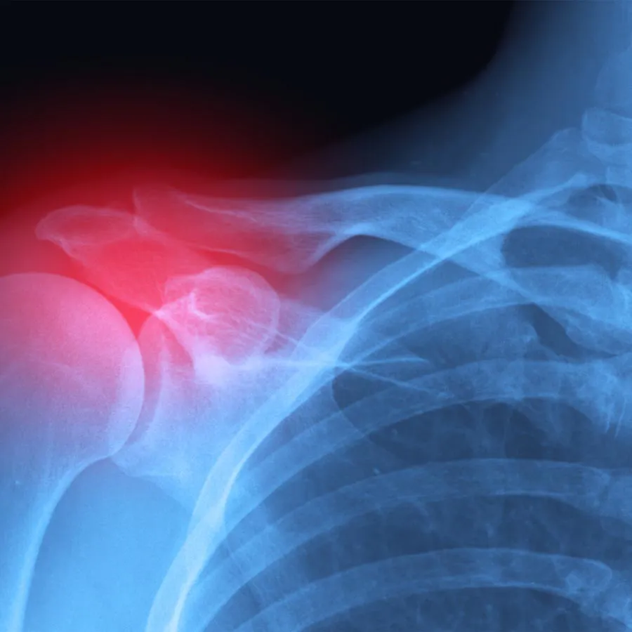 Shoulder Pain St. Petersburg Florida - Hood Chiropractic